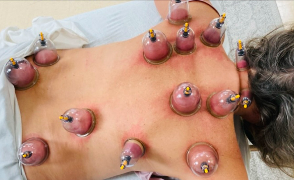 Cupping